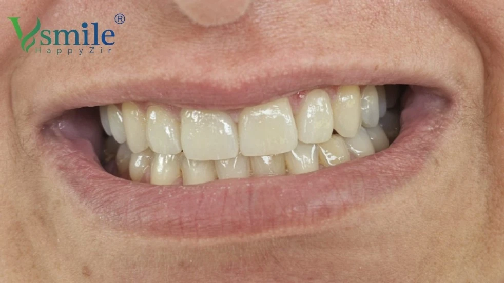 Why Choose Zirconia Crowns Why Choose Zirconia Crowns